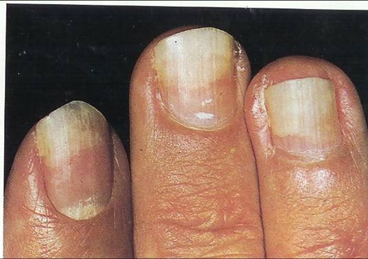 fingernails lifting from nail bed