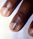 Black spots on nails