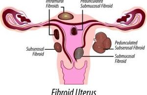FibroidUterus
