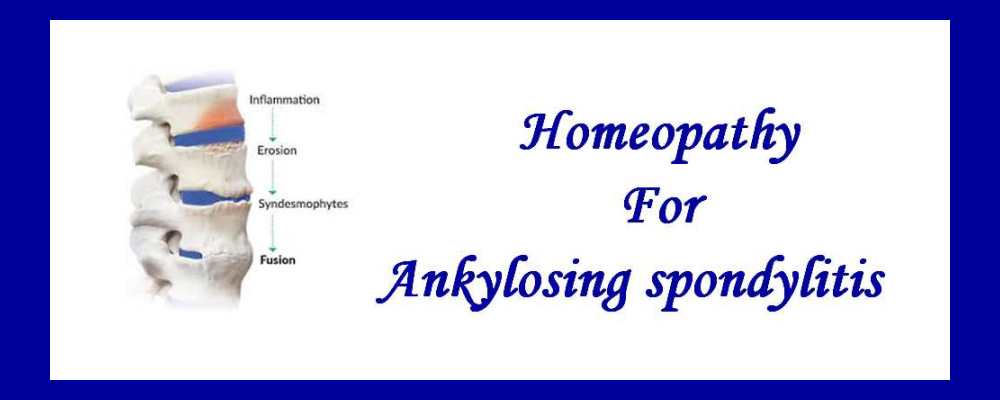 Homeopathic Medicine for Ankylosing Spondylitis