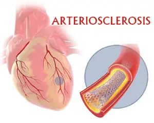 Homeopathic medicine for Arteriosclerosis.
