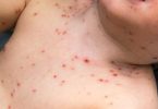 Homeopathic medicine for Chicken pox