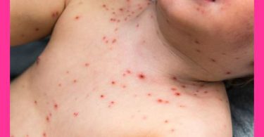 Homeopathic medicine for Chicken pox