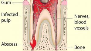 homeopathic medicine for tooth abscess