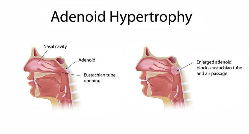 homeopathic medicine for adenoid hypertrophy