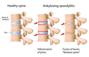 Homeopathic Medicine for Ankylosing spondylitis