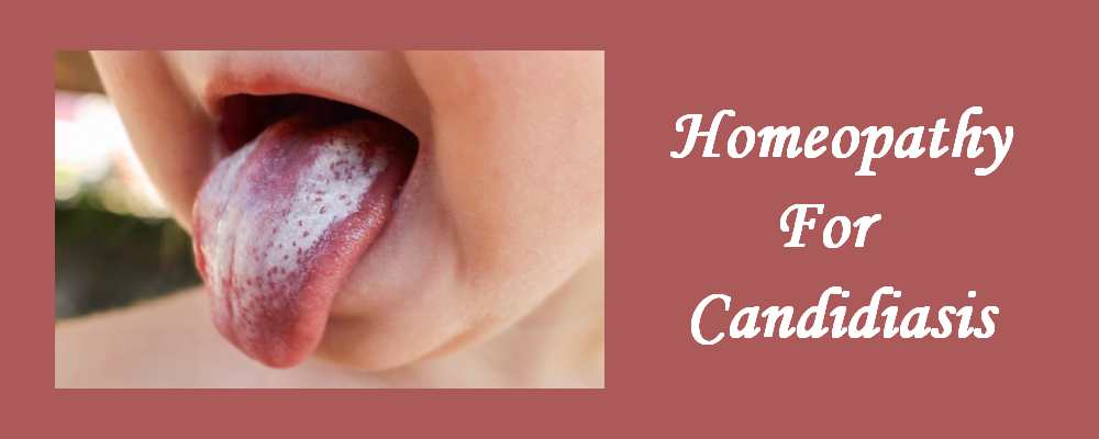 Homeopathic Medicine for Candidiasis