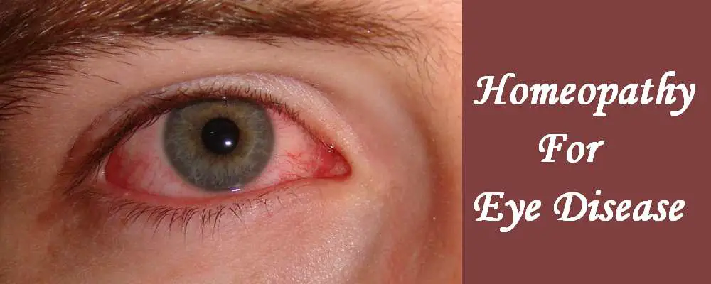 homeopathic medicine for eye disease