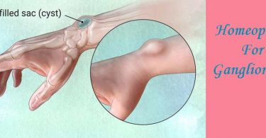 Homeopathic medicine for Ganglion Cyst in Wrist