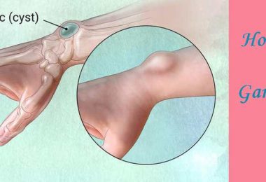 Homeopathic medicine for Ganglion Cyst in Wrist