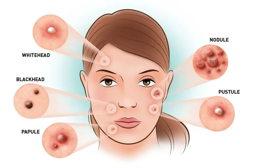 types of acne & homeopathic remedies for different types of acne