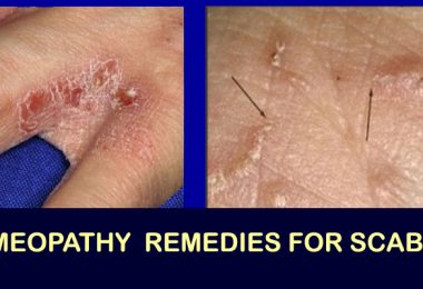 homeopathy scabies remedy
