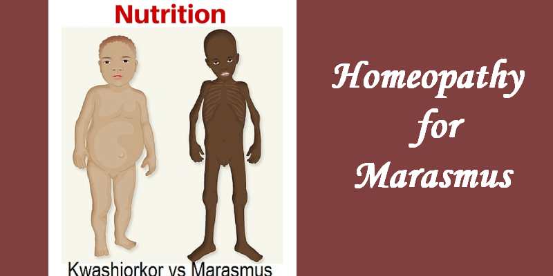 Homeopathic medicine for Marasmus