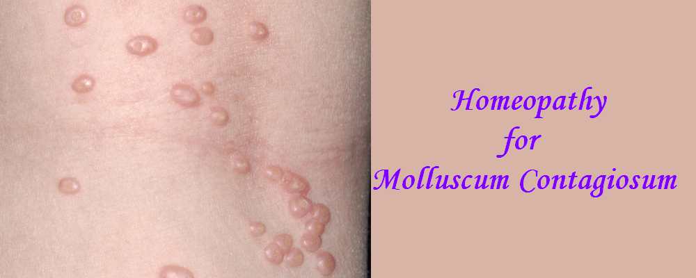 Homeopathic medicine for Molluscum contagiosum