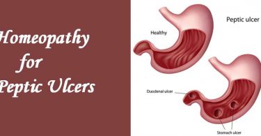 Homeopathic medicines for Peptic Ulcers