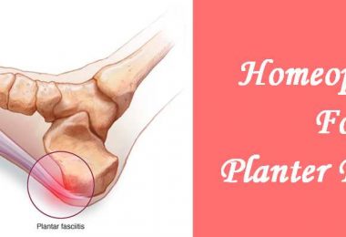 Homeopathic medicine for Plantar Fascitis - Pain in Feet, Soles, Heel