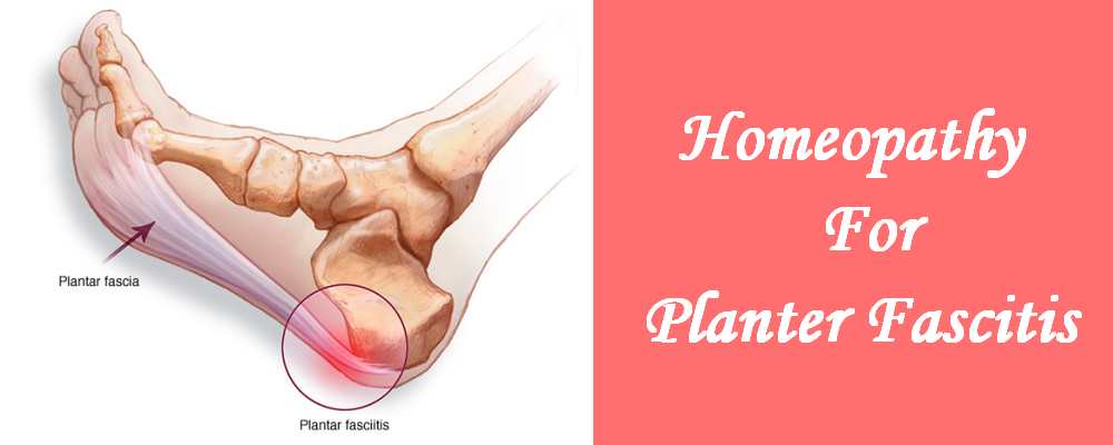 Homeopathic medicine for Plantar Fascitis - Pain in Feet, Soles, Heel