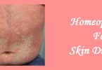 Homeopathic medicine for Skin Diseases