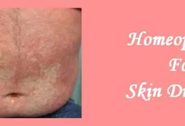 Homeopathic medicine for Skin Diseases