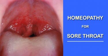 sore throat homeopathy