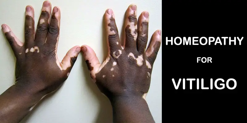 vitiligo homeopathy
