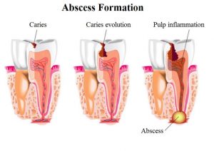 tooth abscess homeopathic medicine for toothache