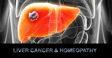 liver cancer homeopathy