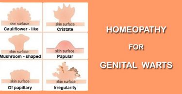 homeopathy cure for genital warts