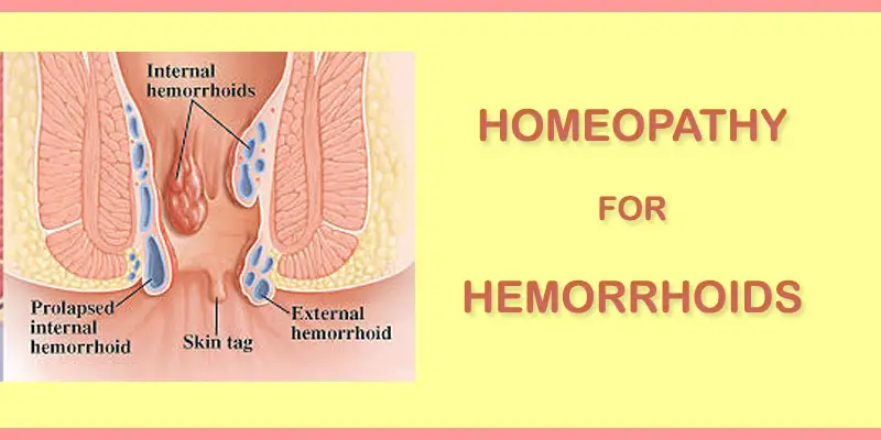 hemorrhoids treatment