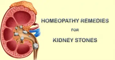 kidney stones homeopathy