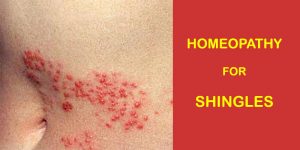 shingles homeopathy