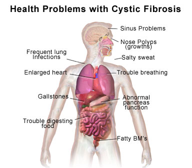 Cystic Fibrosis Treatment
