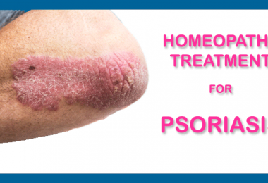 psoriasis homeopathy treatm
