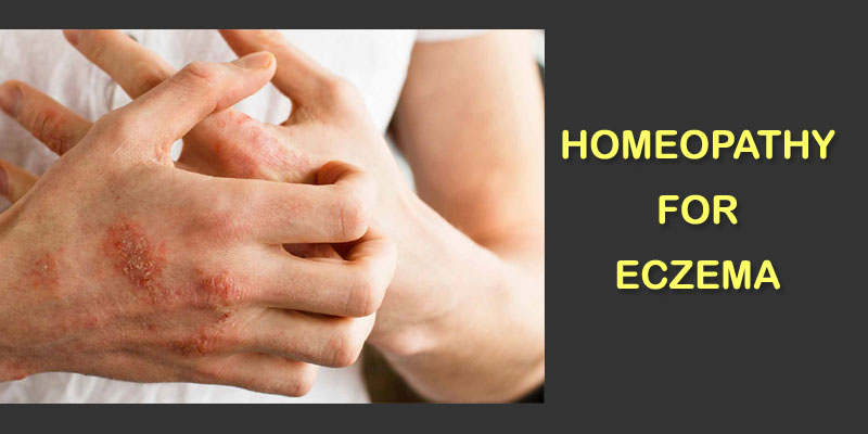 homeopathy treatment for eczema homeopathic remedies