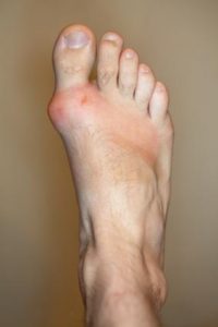 homeopathy for gout pain swelling