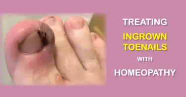 Ingrown toenails treatment