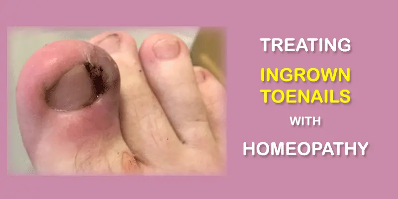 Ingrown toenails treatment