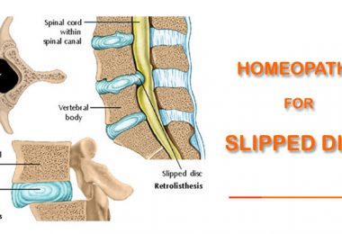 slipped disk homeopathy