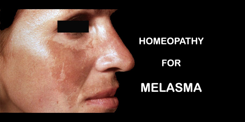 melasma homeopathy