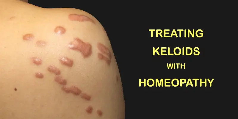 keloid scar removal. How to get rid of keloid scar
