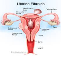 Fibroids in Uterus and Ovarian Cysts