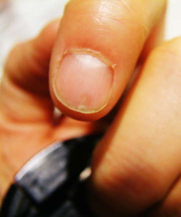 Splinter in Finger Nail