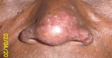 A Case of Eczema on Nose and its Homoeopathic treatment