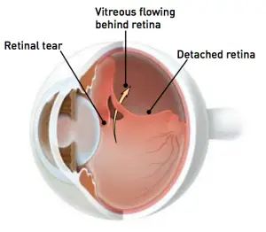 detached-retina