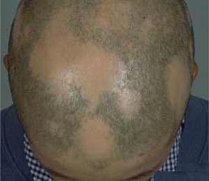 homeopathy remedies for alopecia areata hair loss