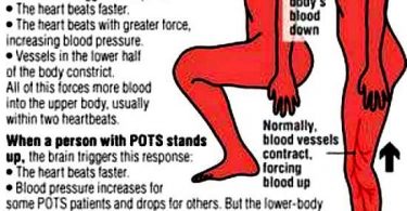 POTS How POTS affects the body
