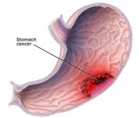 Stomach Cancer