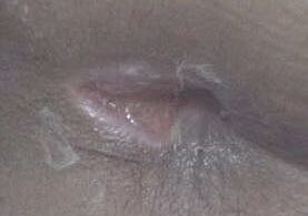 fistula anus