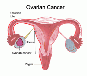 ovarian_cancer