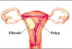 uterine polips